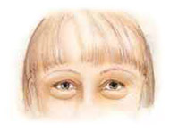 Eyelid surgery before pic