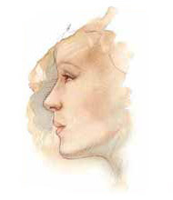 Nose surgery (Rhinoplasty) after picture.
